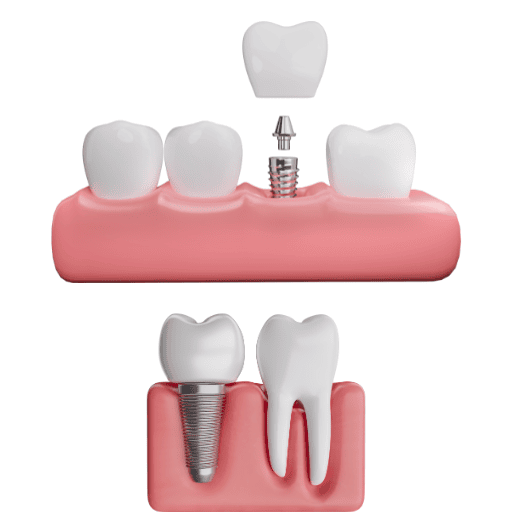 What are Dental implants?